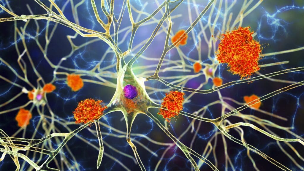 an illustration of nerve cells with plaques around them