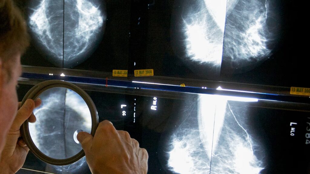 When should you get a mammogram? Conflicting advice makes it hard to know When should you get a mammogram? Conflicting advice makes it hard to know