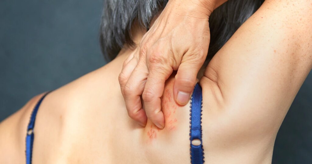 Shingles is linked to inflammation in the brain. Research shows how to cut dementia risk.