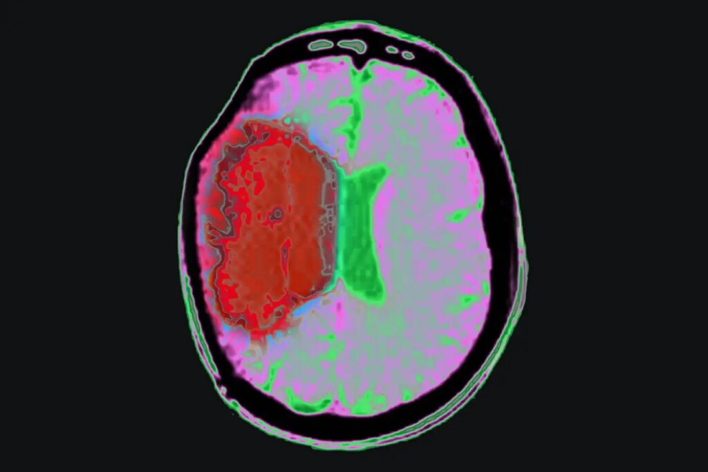 Chilling the body with drugs could limit brain damage from stroke Chilling the body with drugs could limit brain damage from stroke