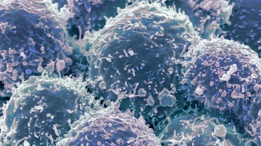 Guidelines Help Spot Dermatomyositis Patients at High Risk for Cancer A scanning electron microscope image of lung cancer cells.