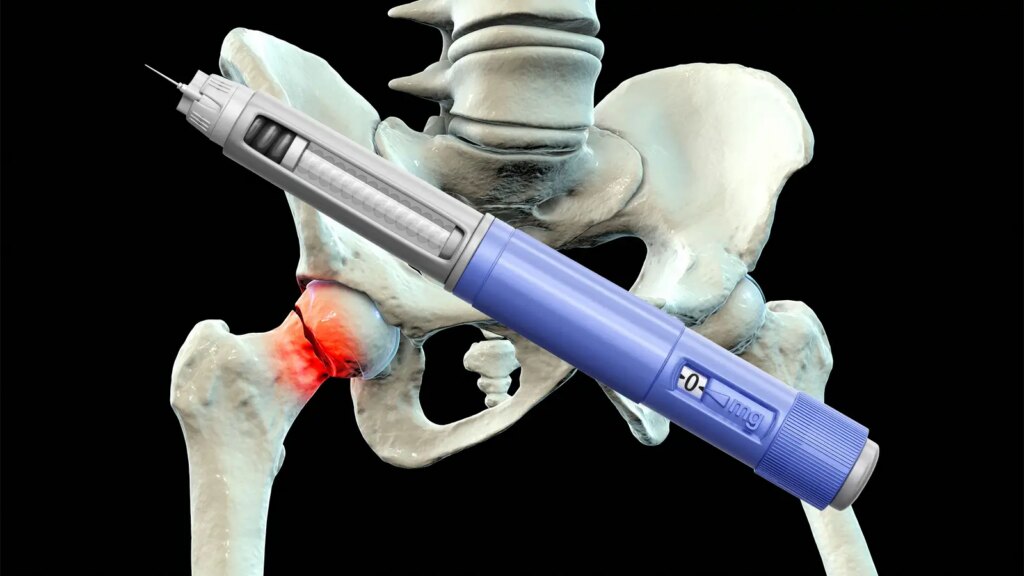 Study Links GLP-1s to Lower Risk of Fragility Fractures in Diabetes Patients A computer rendering of an injection pen over a pelvis with a hip fracture.