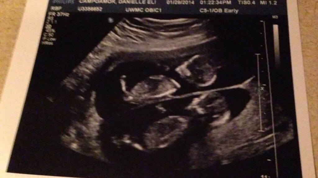 An Ultrasound At 20 Weeks Pregnant Revealed The Unthinkable An Ultrasound At 20 Weeks Pregnant Revealed The Unthinkable